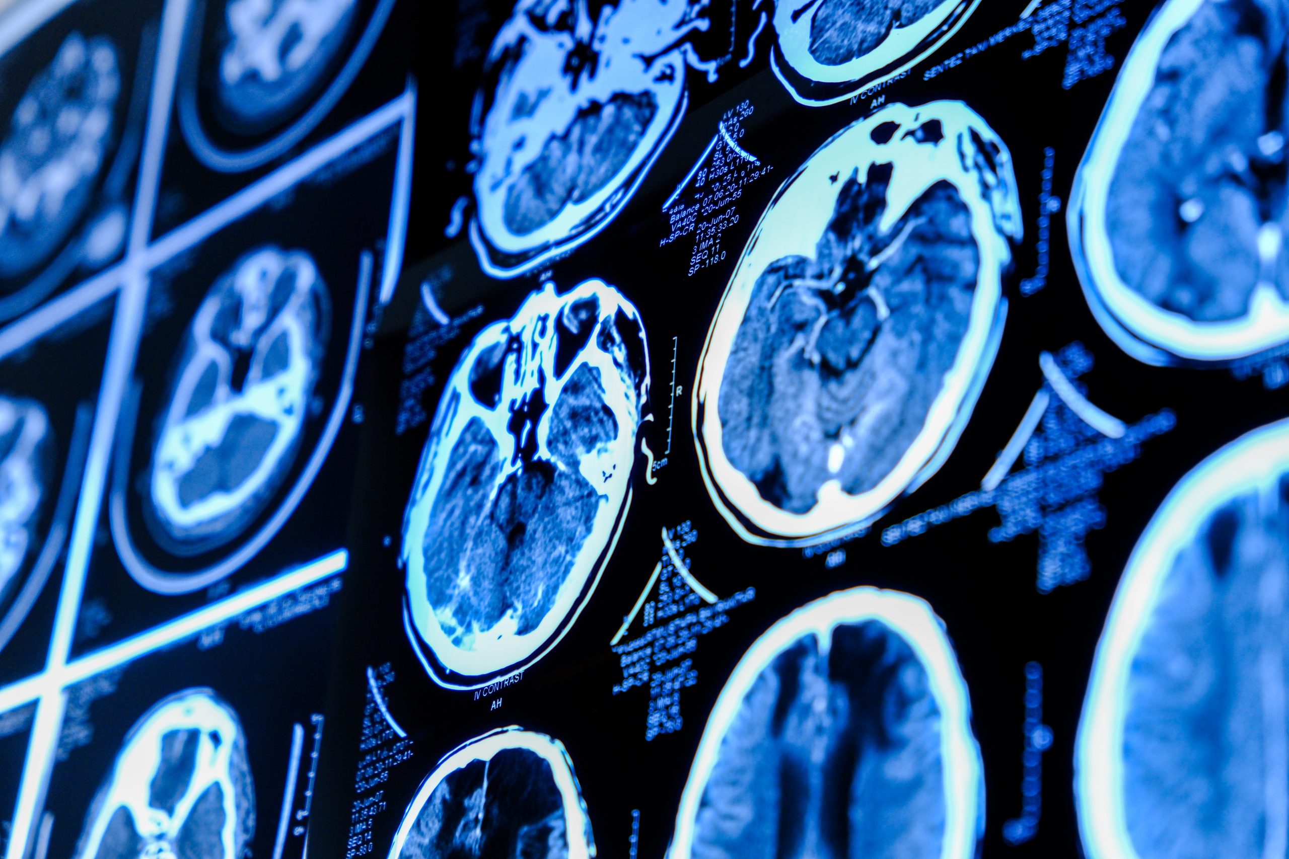 How the American Brain Foundation’s Targeting a Key Element in Neurological Health 